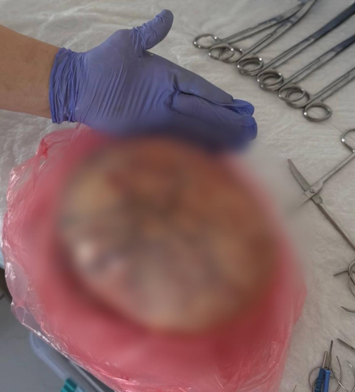 Рівненські онкохірурги видалили пухлину вагою понад 4 кг