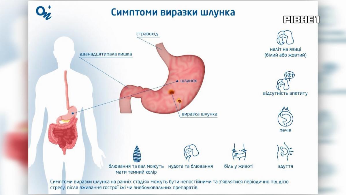Будьте здорові: Виразка шлунку: причини, небезпечні симптоми та поради лікаря